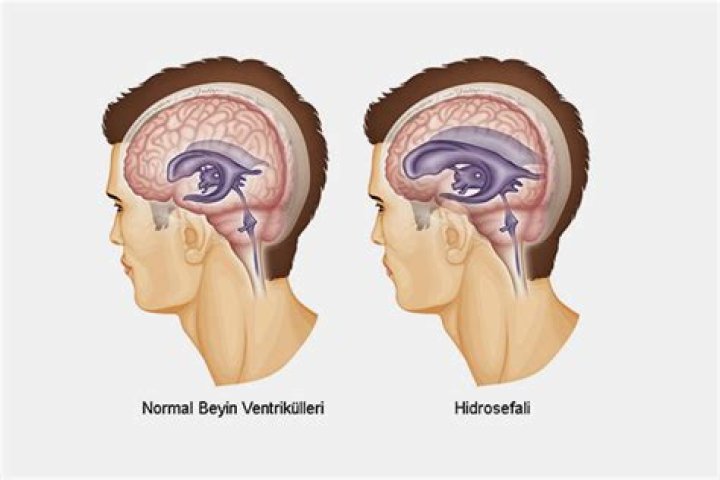 Hidrosefali nedir